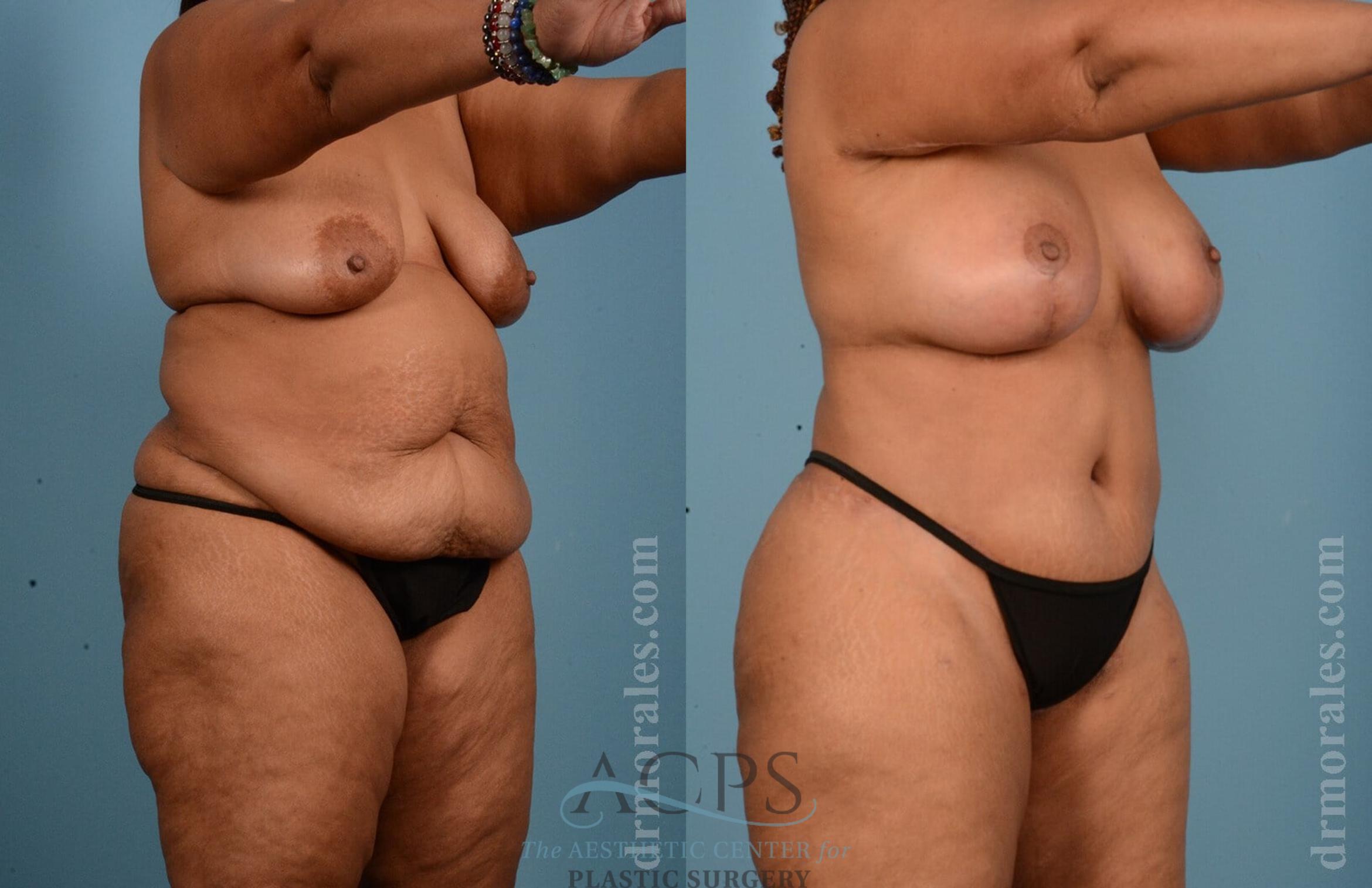 Before & After Body Lift Case 704 Oblique View: View in Houston, TX