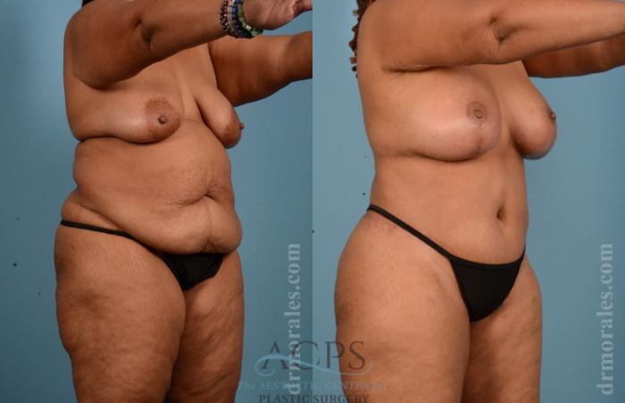 Before & After Body Lift Case 704 Oblique View: View in Houston, TX