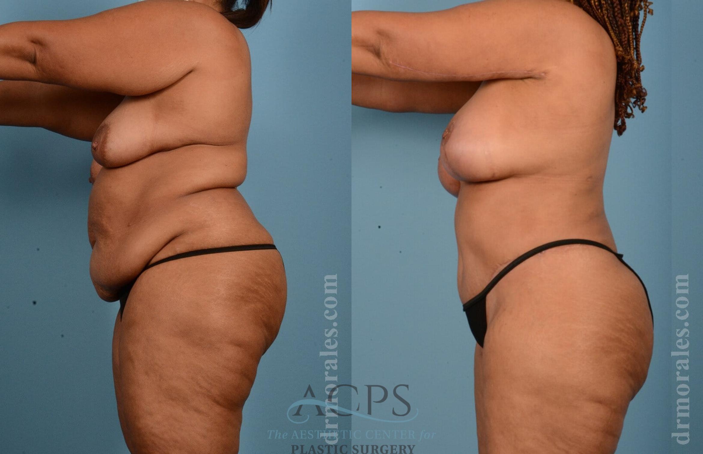 Before & After Body Lift Case 704 Side View: View in Houston, TX