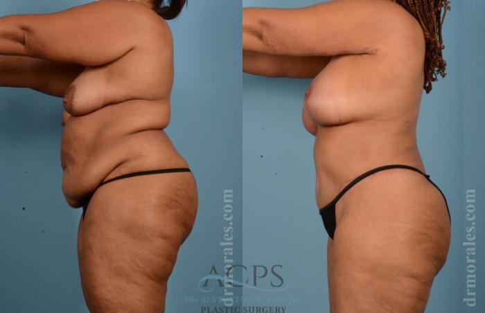 Before & After Body Lift Case 704 Side View: View in Houston, TX