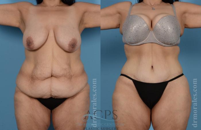 Before & After Body Lift Case 705 Front View: View in Houston, TX