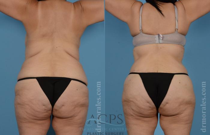 Before & After Body Lift Case 705 Rear View: View in Houston, TX