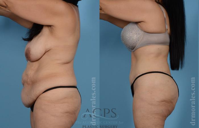 Before & After Body Lift Case 705 Side View: View in Houston, TX