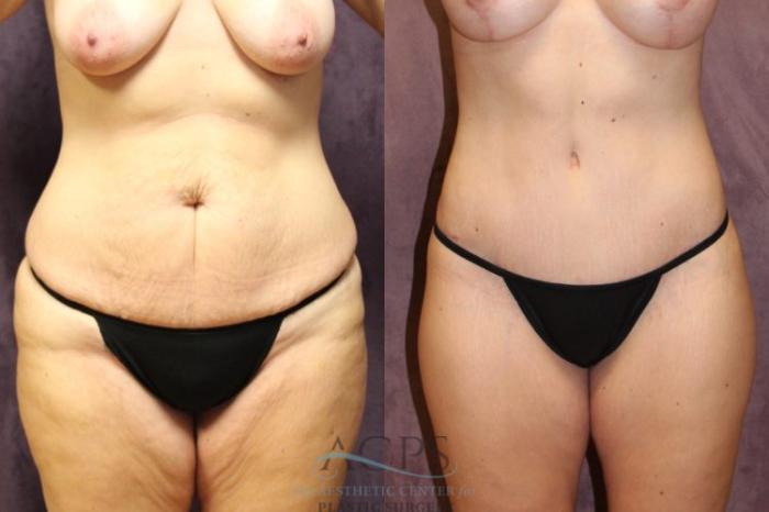 Before & After Body Lift Case 706 Front View: View in Houston, TX