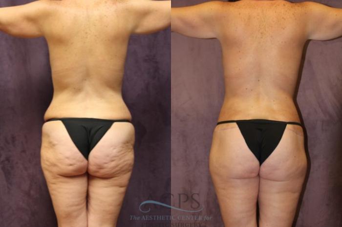 Before & After Body Lift Case 706 Rear View: View in Houston, TX