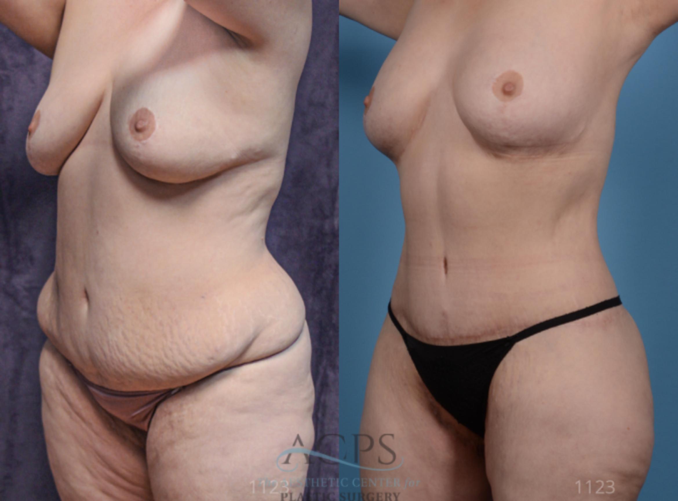Before & After Body Lift Case 707 Oblique View: View in Houston, TX