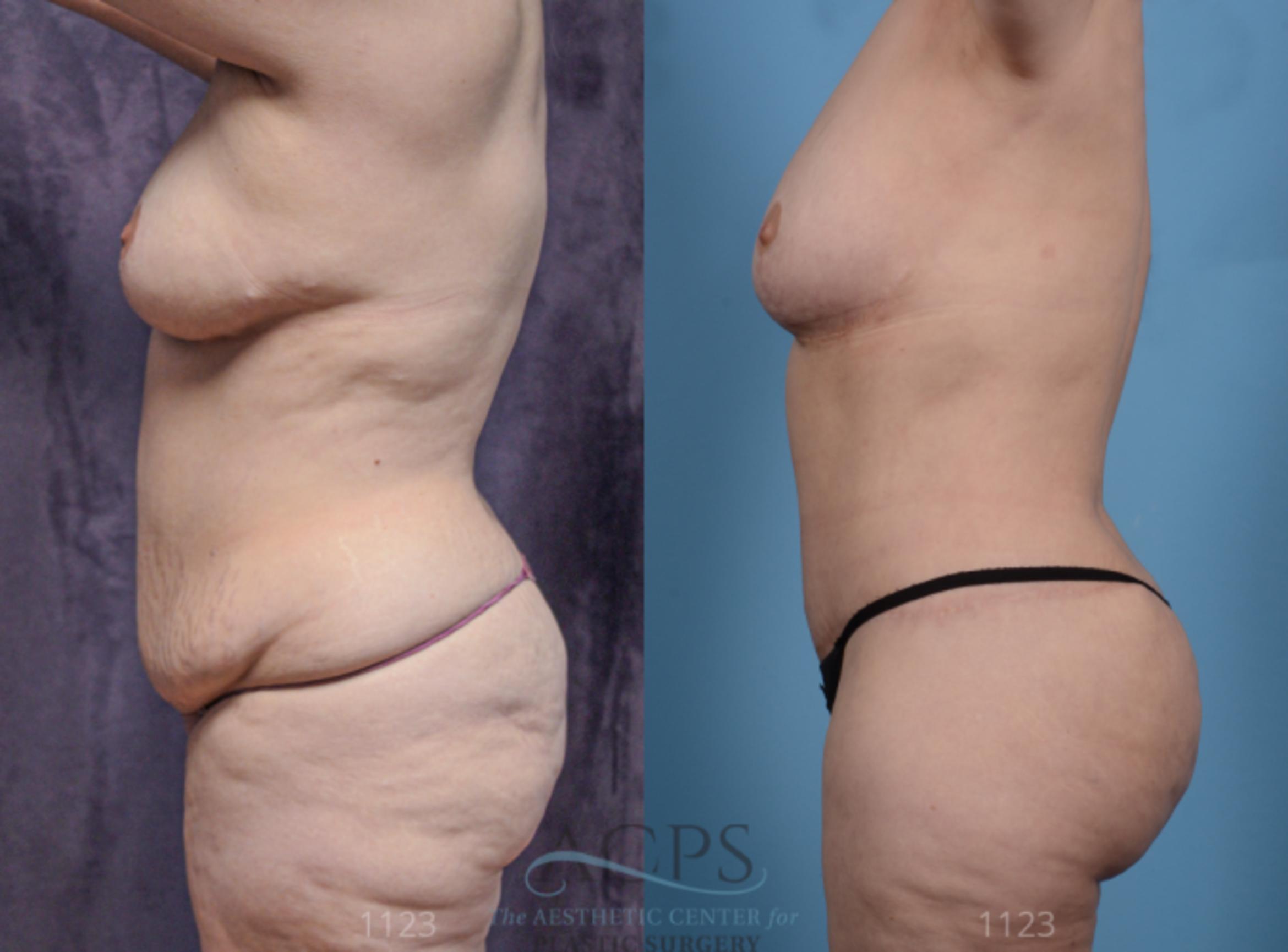 Before & After Body Lift Case 707 Side View: View in Houston, TX