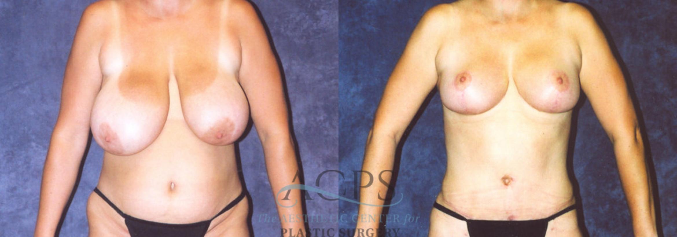 Before & After Body Lift Case 716 Front View: View in Houston, TX