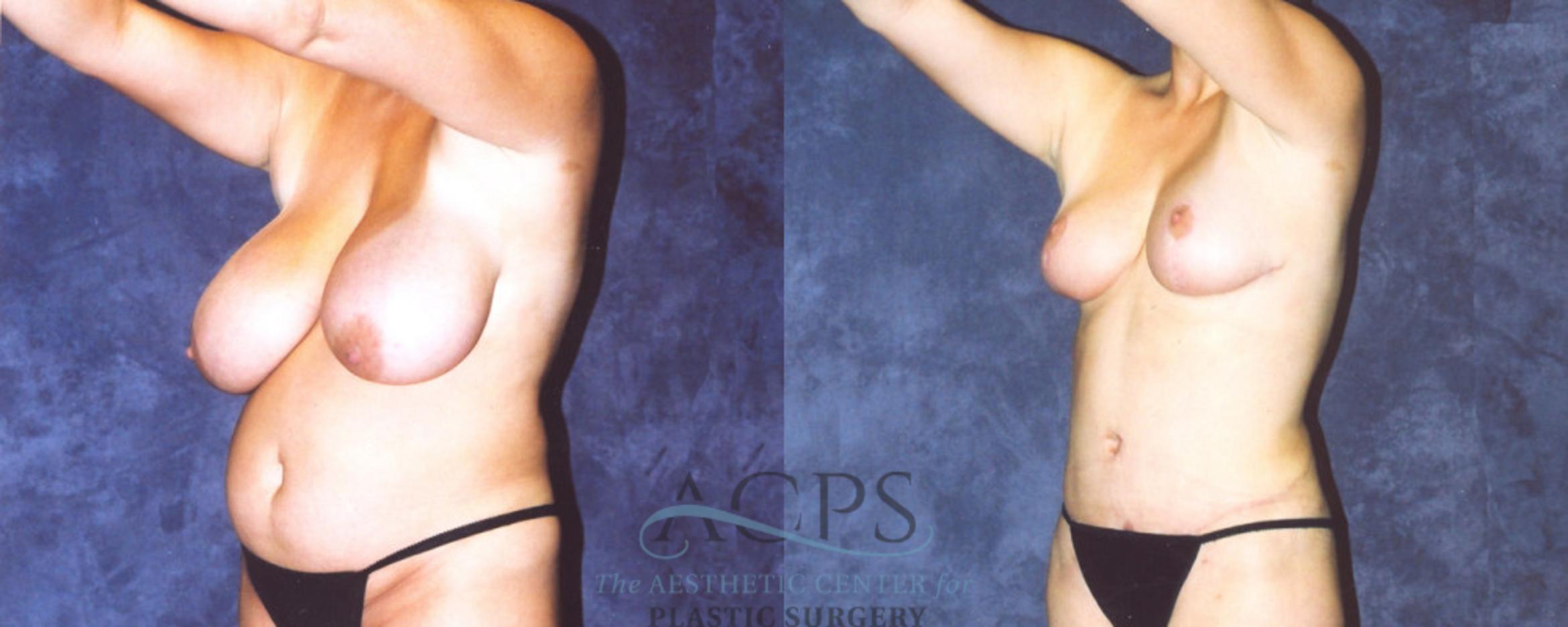 Before & After Body Lift Case 716 Oblique View: View in Houston, TX