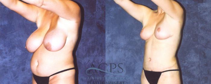Before & After Body Lift Case 716 Oblique View: View in Houston, TX