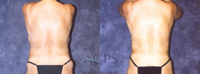 Before & After Body Lift Case 716 Rear View: View in Houston, TX