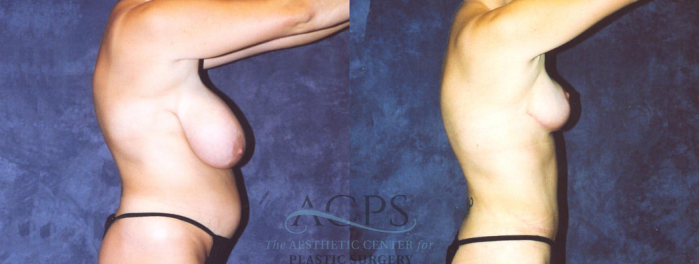 Before & After Body Lift Case 716 Side View: View in Houston, TX