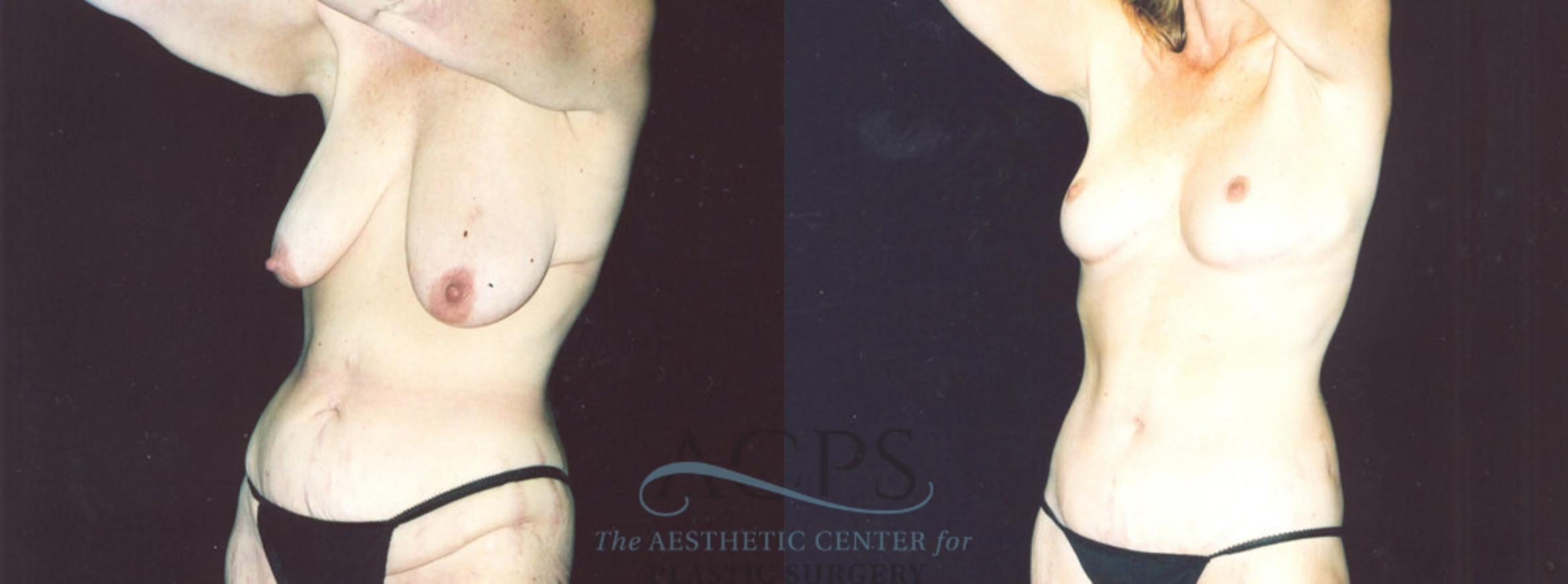 Before & After Body Lift Case 717 Oblique View: View in Houston, TX