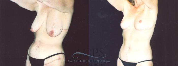 Before & After Body Lift Case 717 Oblique View: View in Houston, TX