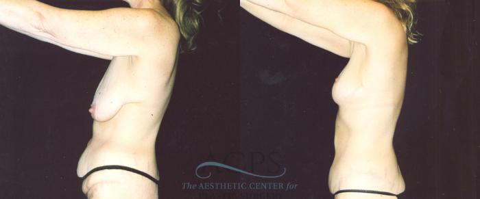 Before & After Body Lift Case 717 Side View: View in Houston, TX