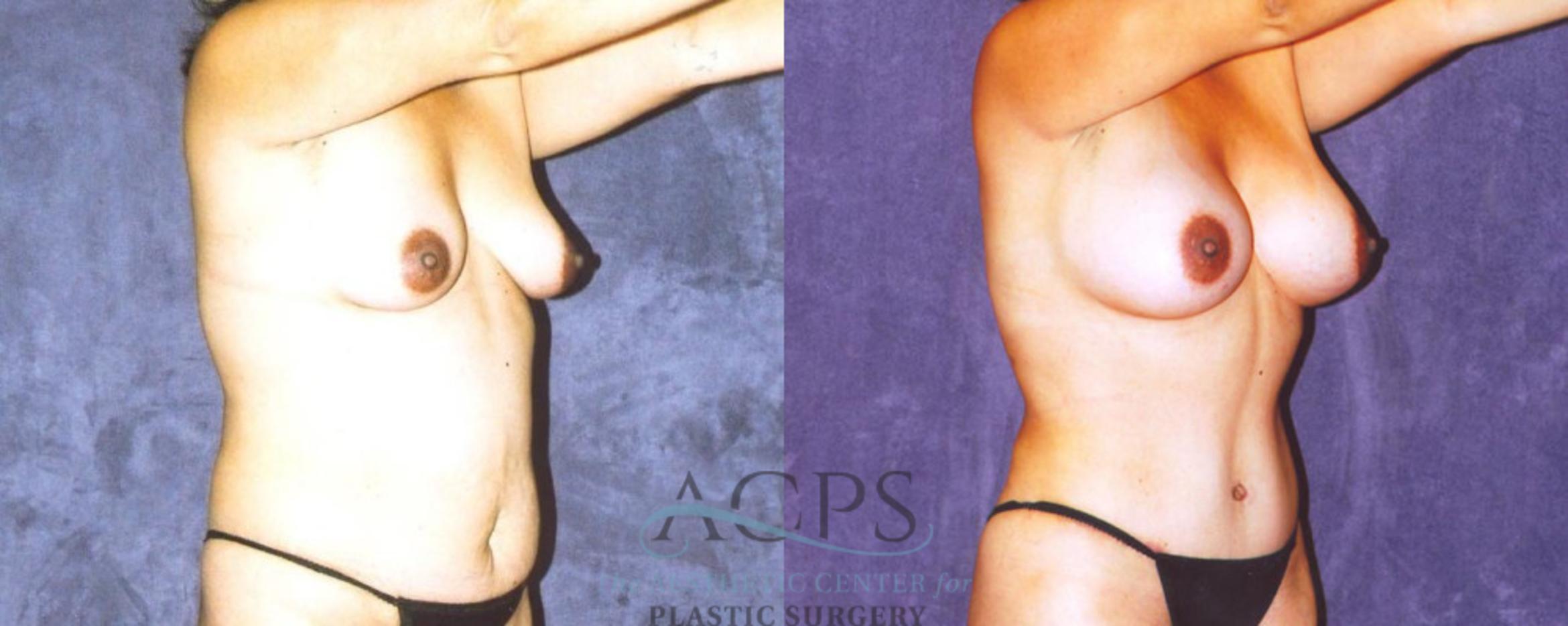 Before & After Body Lift Case 718 Oblique View: View in Houston, TX