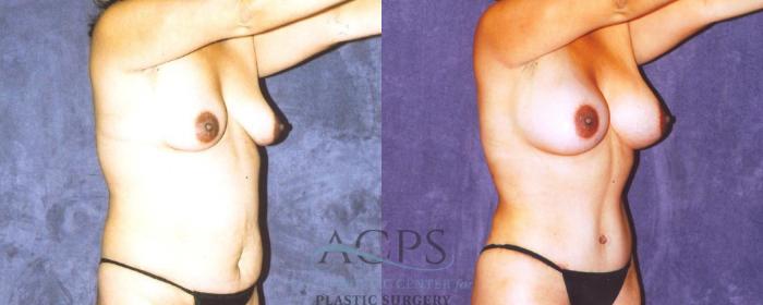 Before & After Body Lift Case 718 Oblique View: View in Houston, TX