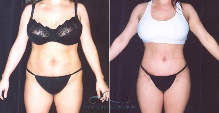 Before & After Body Lift Case 719 Front View: View in Houston, TX