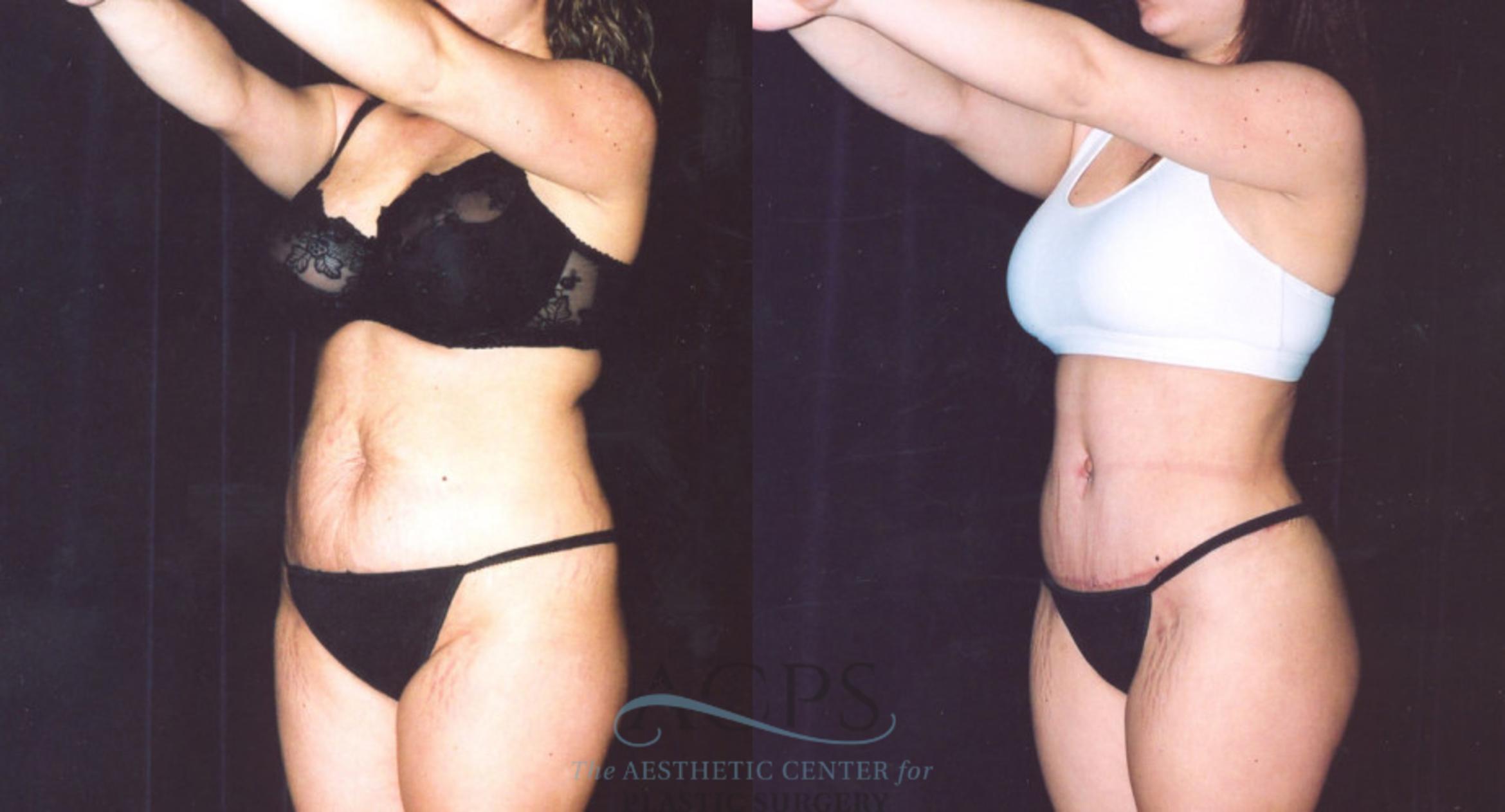Before & After Body Lift Case 719 Oblique Left View: View in Houston, TX