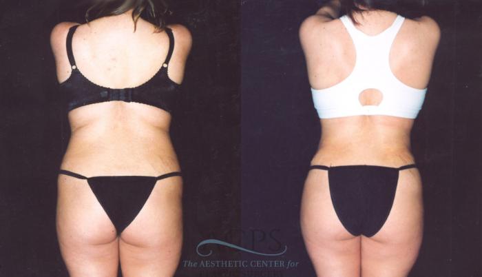 Before & After Body Lift Case 719 Rear View: View in Houston, TX