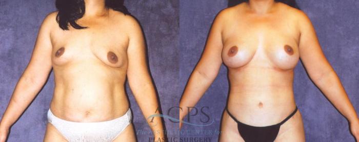 Before & After Body Lift Case 720 Front View: View in Houston, TX