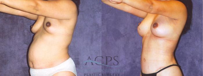 Before & After Body Lift Case 720 Oblique View: View in Houston, TX