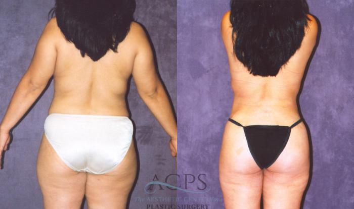 Before & After Body Lift Case 720 Rear View: View in Houston, TX