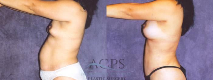 Before & After Body Lift Case 720 Side View: View in Houston, TX