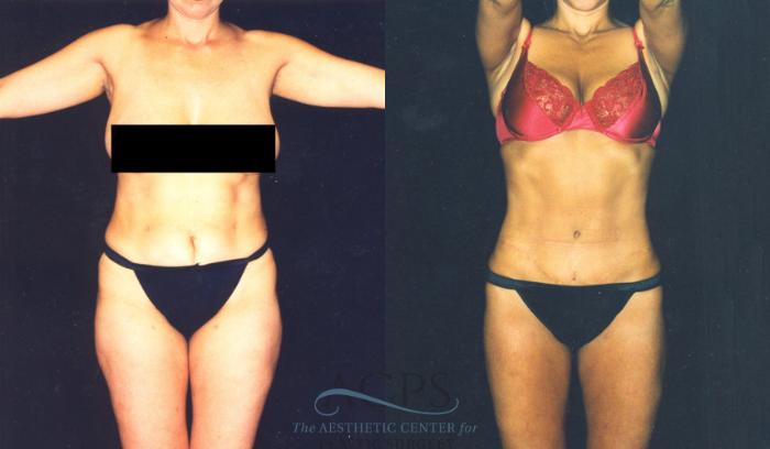 Before & After Body Lift Case 721 Front View: View in Houston, TX
