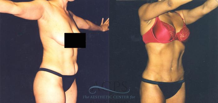 Before & After Body Lift Case 721 Oblique View: View in Houston, TX