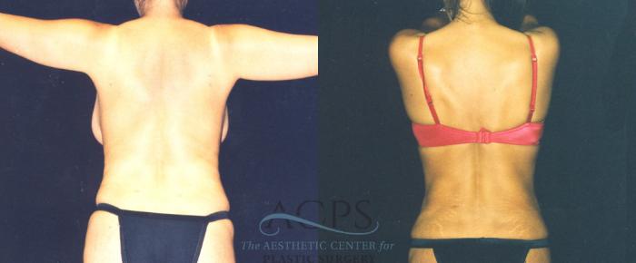 Before & After Body Lift Case 721 Rear View: View in Houston, TX