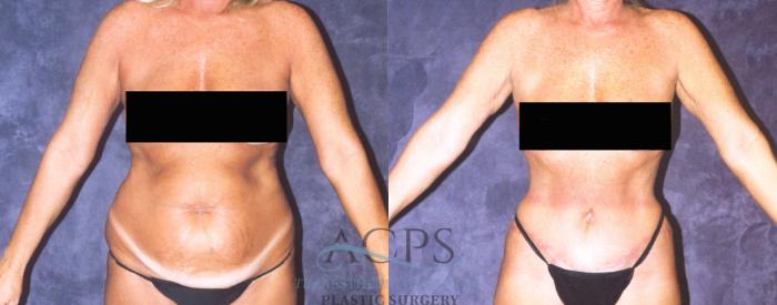 Before & After Body Lift Case 722 Front View: View in Houston, TX