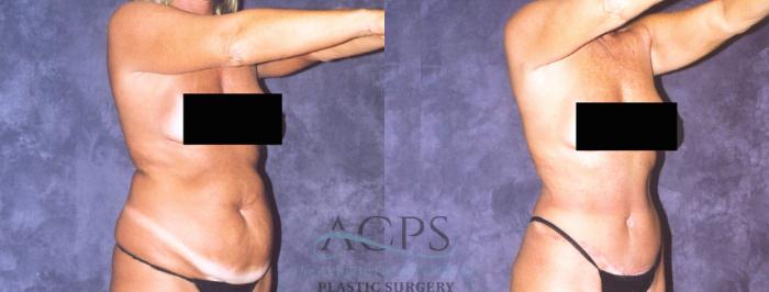 Before & After Body Lift Case 722 Oblique View: View in Houston, TX