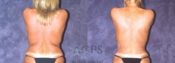 Before & After Body Lift Case 722 Rear View: View in Houston, TX