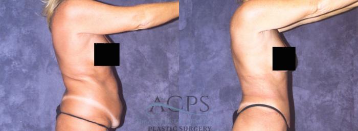 Before & After Body Lift Case 722 Side View: View in Houston, TX