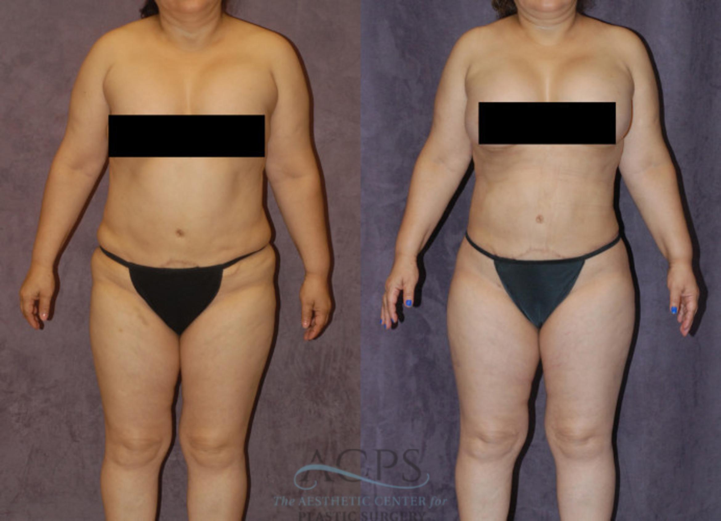 Before & After Body Lift Case 723 Front View: View in Houston, TX