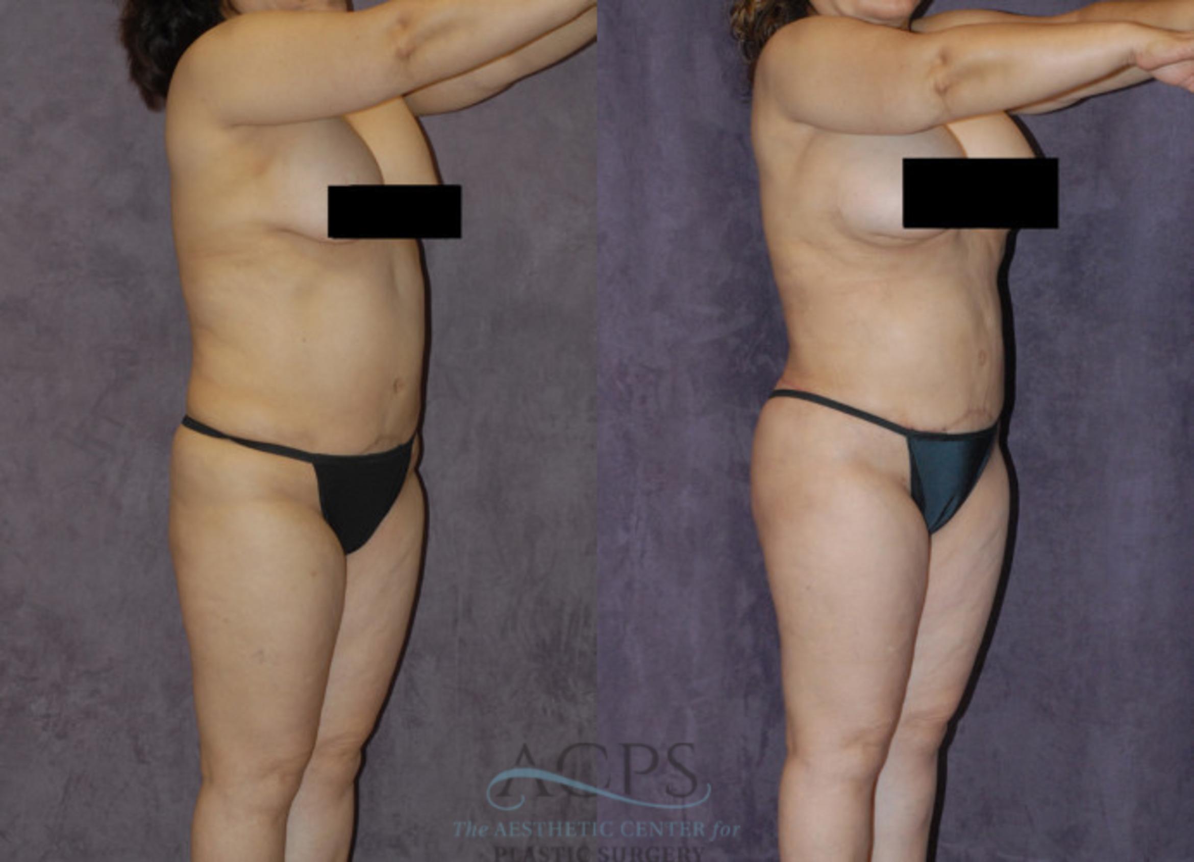 Before & After Body Lift Case 723 Oblique View: View in Houston, TX