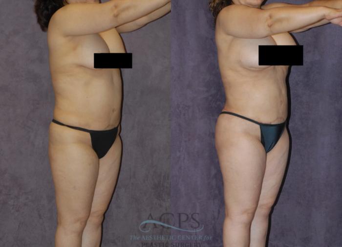 Before & After Body Lift Case 723 Oblique View: View in Houston, TX