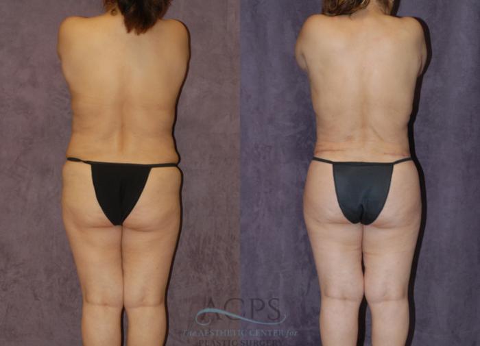 Before & After Body Lift Case 723 Rear View: View in Houston, TX