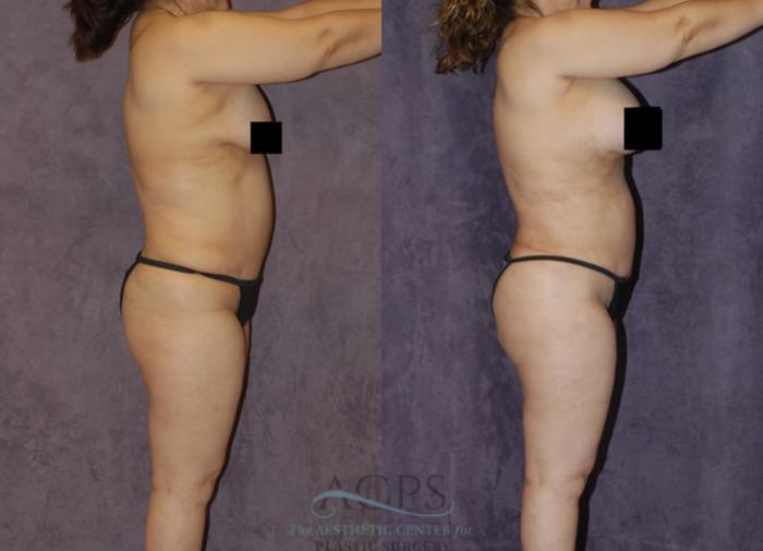 Before & After Body Lift Case 723 Side View: View in Houston, TX
