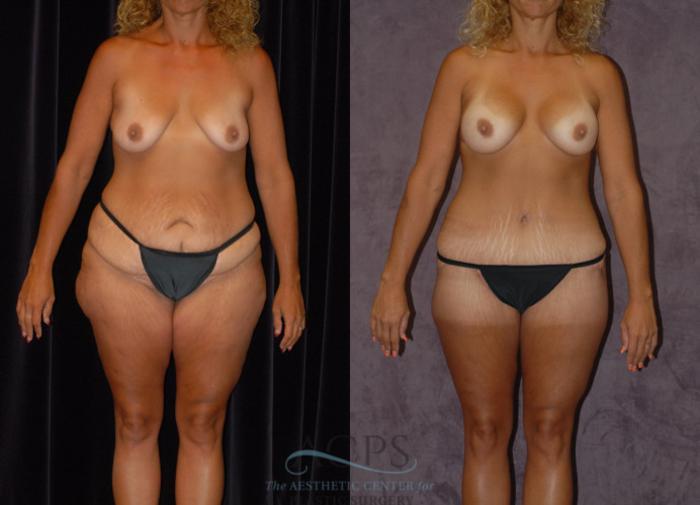 Before & After Body Lift Case 724 Front View: View in Houston, TX