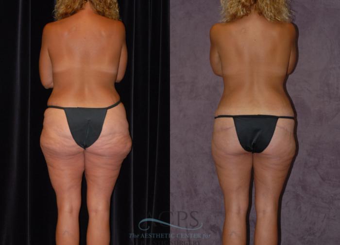 Before & After Body Lift Case 724 Rear View: View in Houston, TX