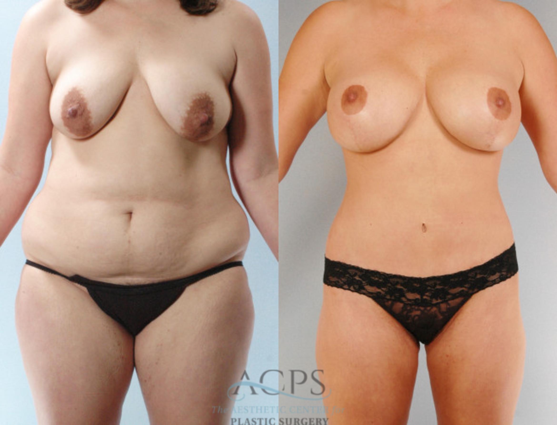 Before & After Body Lift Case 732 Front View: View in Houston, TX