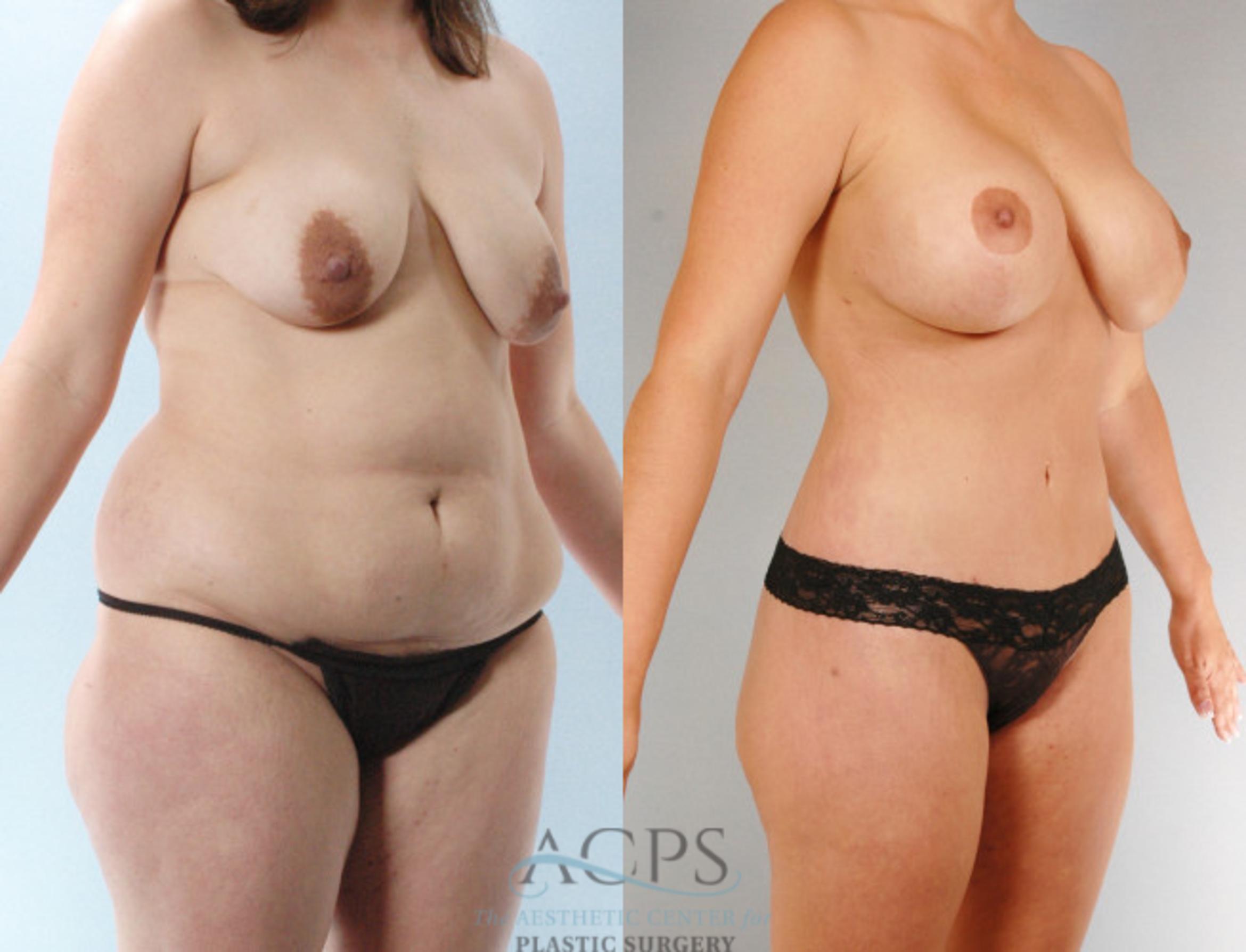 Before & After Body Lift Case 732 Oblique View: View in Houston, TX