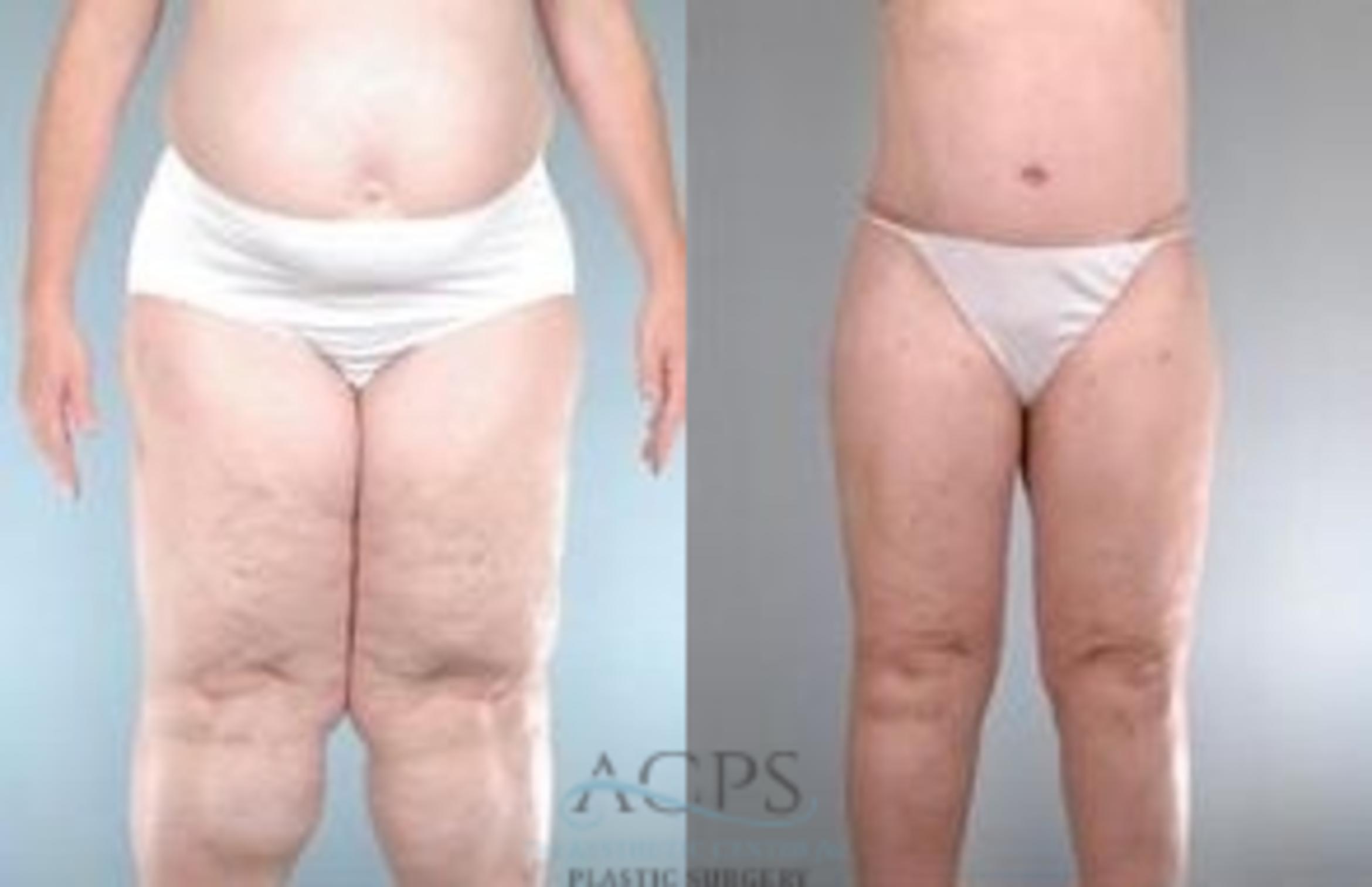 Before & After Body Lift Case 765 Front View: View in Houston, TX