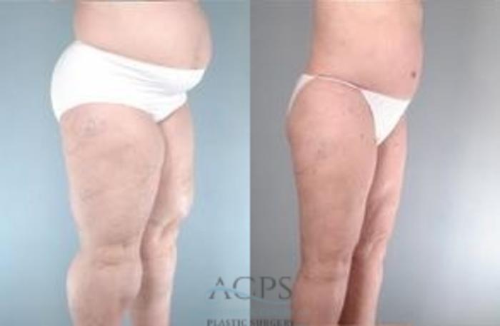 Before & After Body Lift Case 765 Oblique View: View in Houston, TX