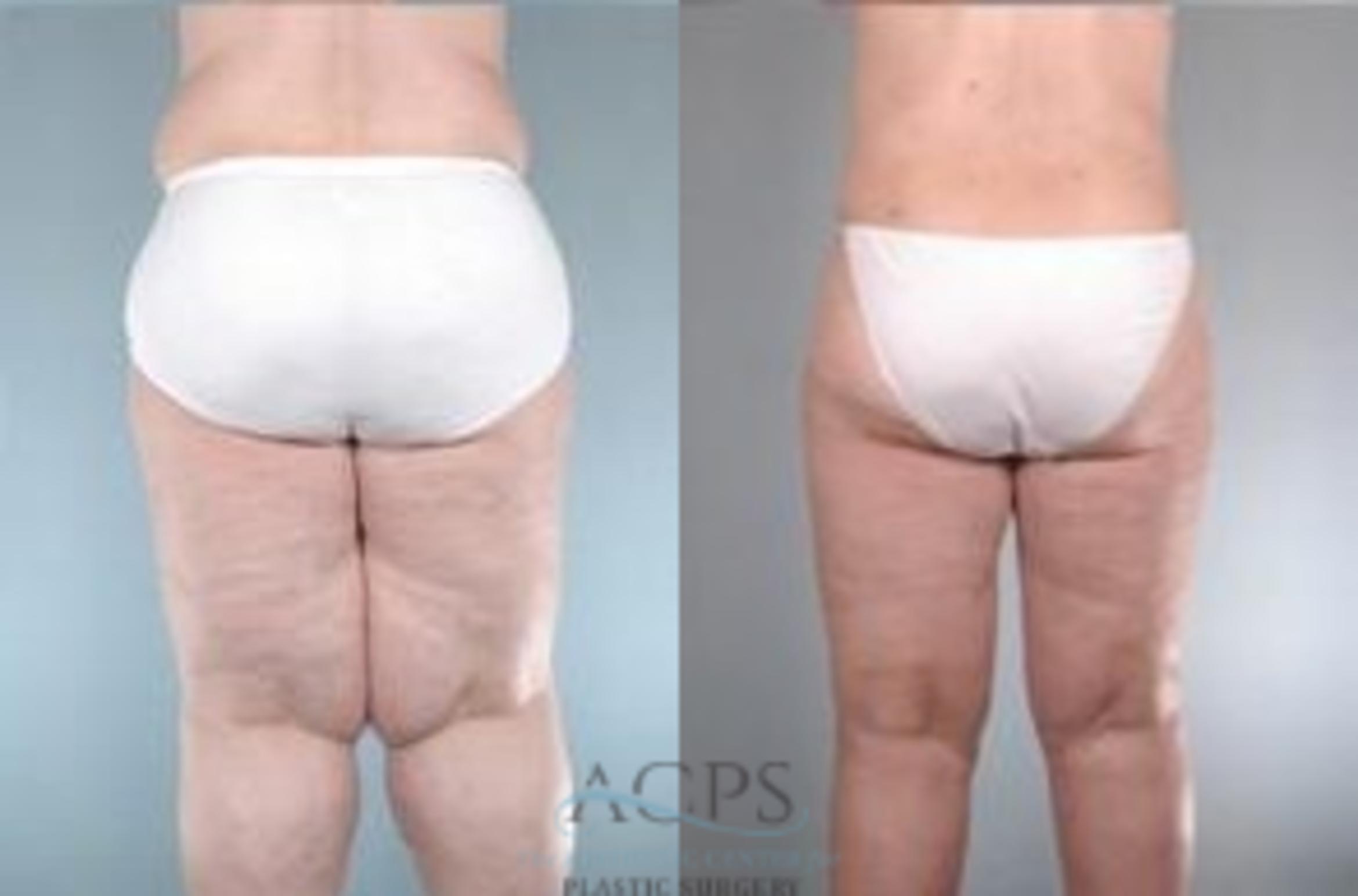 Before & After Body Lift Case 765 Rear View: View in Houston, TX