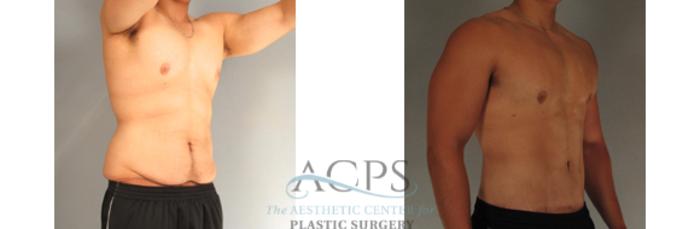 Before & After Body Lift Case 766 Oblique View: View in Houston, TX