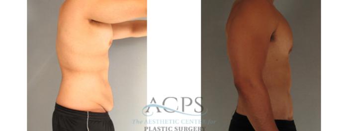Before & After Body Lift Case 766 Side View: View in Houston, TX