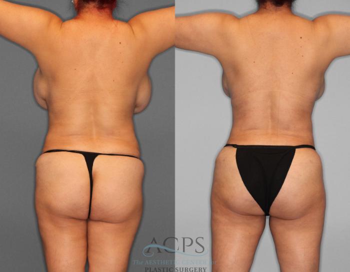 Before & After Brazilian Butt Lift (BBL) Case 403 Rear View: View in Houston, TX